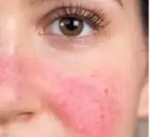 A close up of the face of a person with pink patches on their skin.