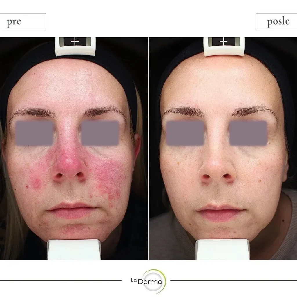 A woman with acne and redness on her face.