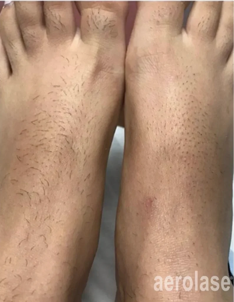 A person 's feet with hairy legs and bare feet.