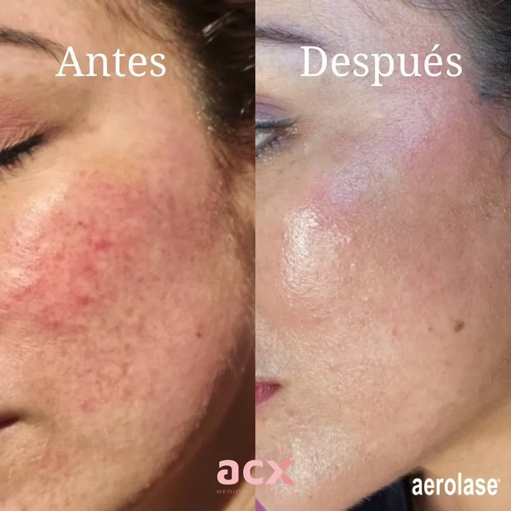 A woman with acne and redness on her face.