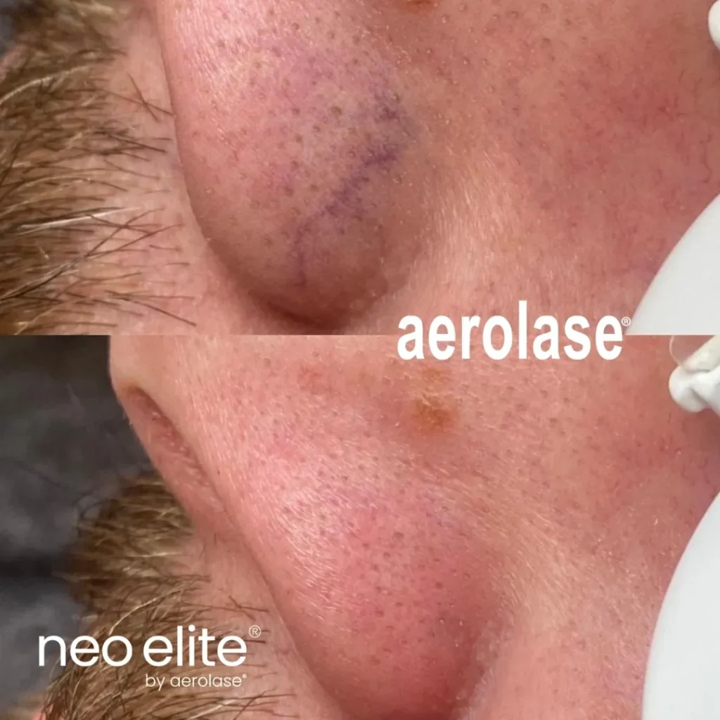 A before and after photo of the nose area.