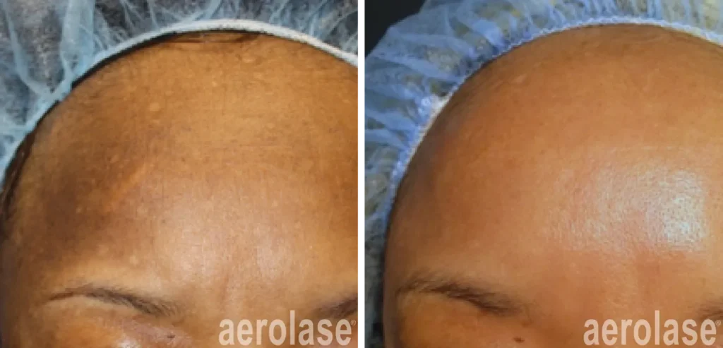 A before and after picture of a person 's forehead.