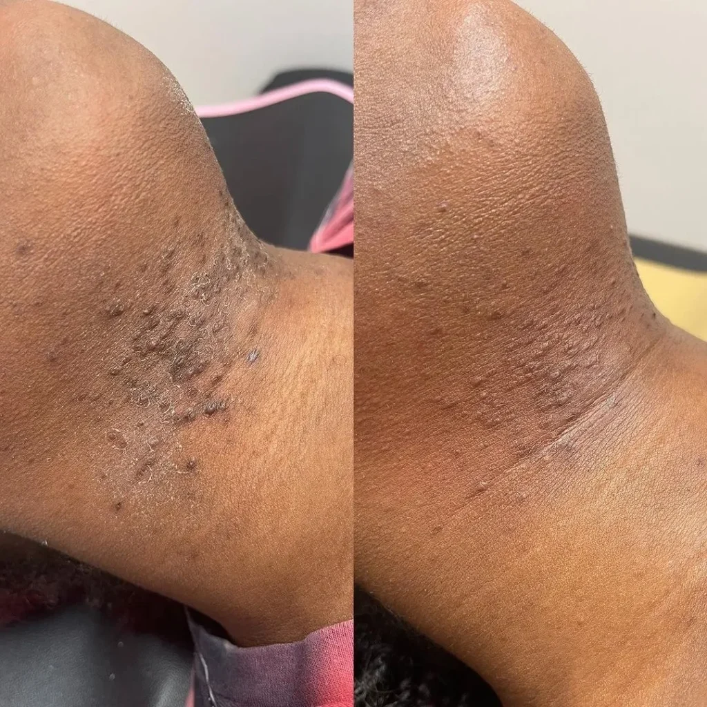 A before and after picture of the back of someone 's leg.