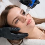 A woman getting her face dermabraded by an esthetician.