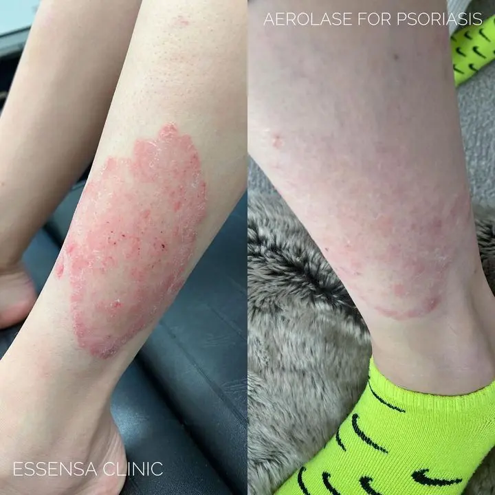 Neo Elite® - Psoriasis (2)